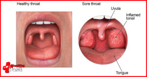 Causes of Sore Throat