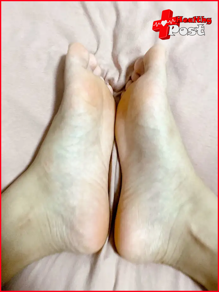 Athlete's foot