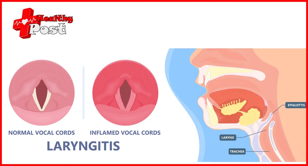 Laryngitis in Children